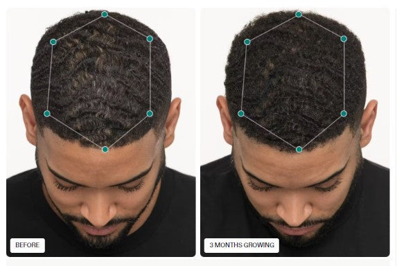 Nutrafol Men- Hair Growth Nutraceutical - 120 capsules - SkinElite - before and after 2