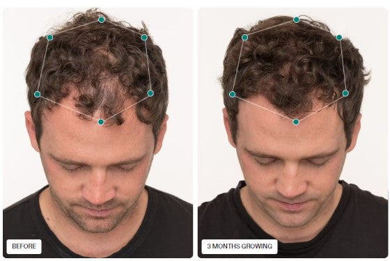 Nutrafol Men- Hair Growth Nutraceutical - 120 capsules - SkinElite - before and after 1