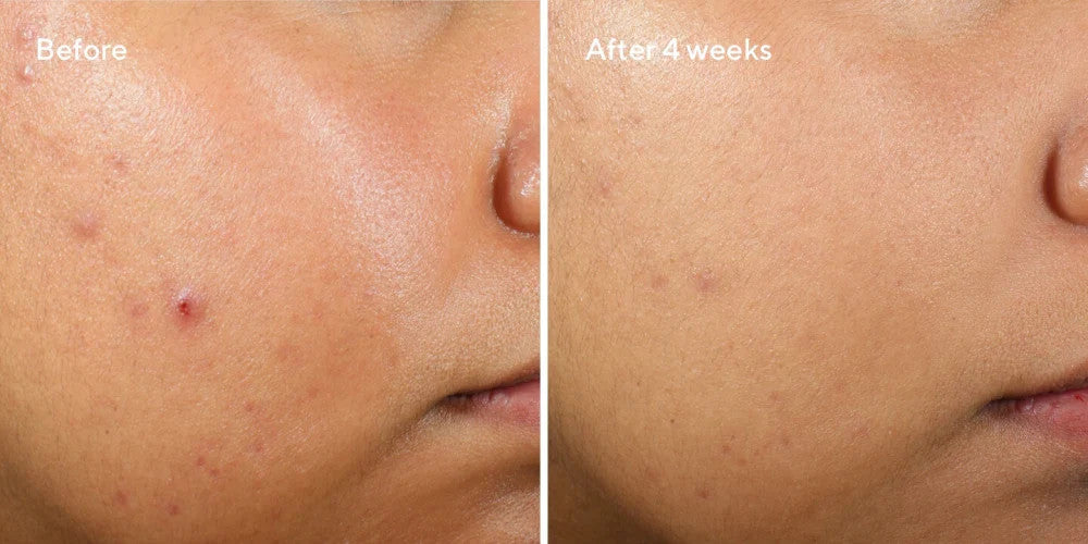 Murad Clarifying Water Gel 2 oz- clearer skin after 4 weeks