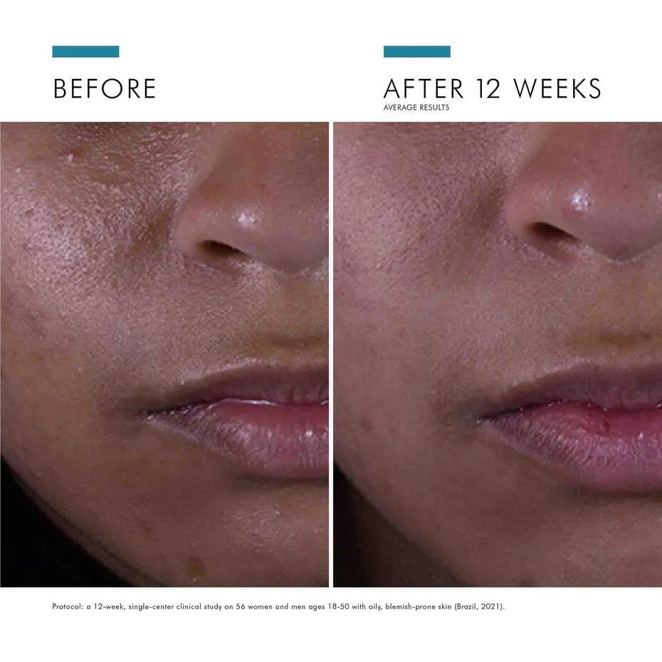 SkinCeuticals Silymarin CF Salicylic Acid Acne Treatment 1 fl oz before and after