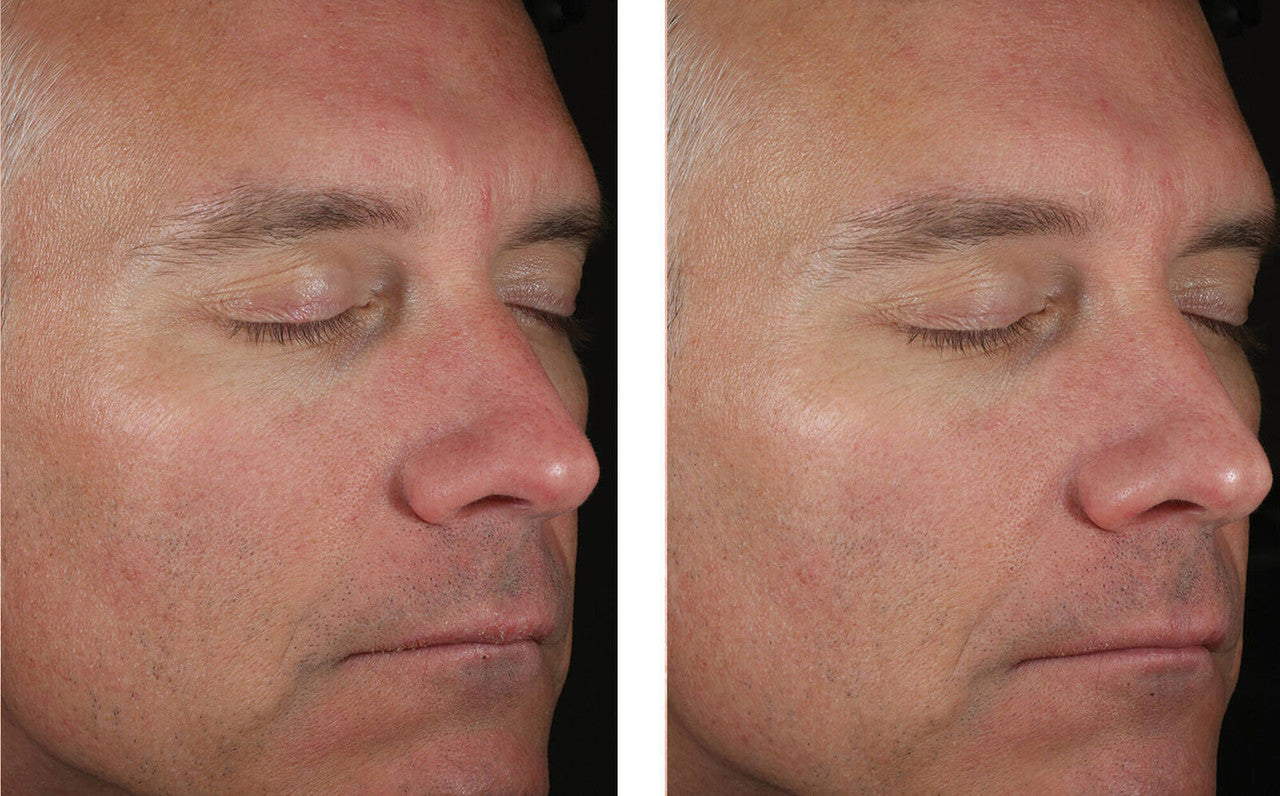 SkinBetter Solo Hydrating Defense Men 1.7 fl oz - SkinElite - before and after 1