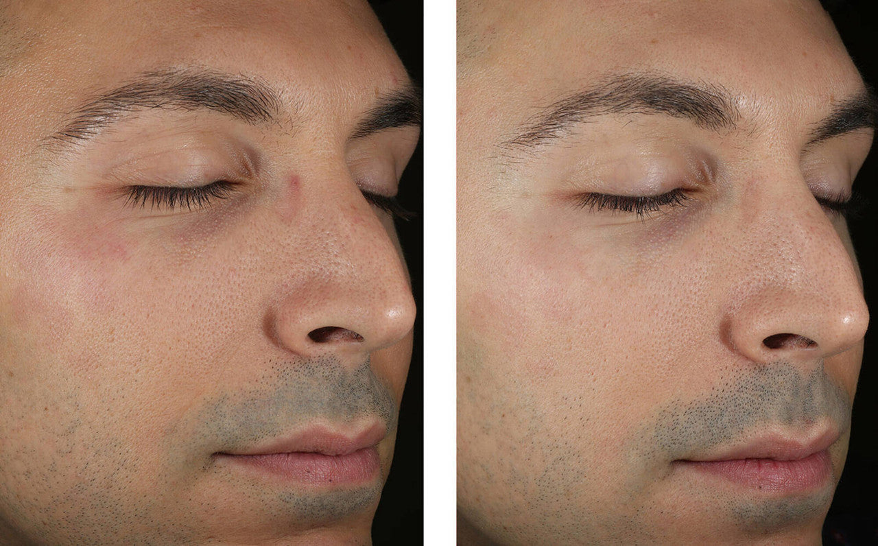 SkinBetter Solo Hydrating Defense Men 1.7 fl oz - SkinElite - before and after 3