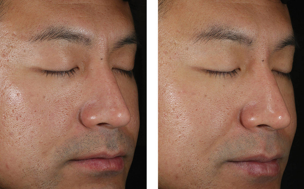 SkinBetter Solo Hydrating Defense Men 1.7 fl oz - SkinElite - before and after 4