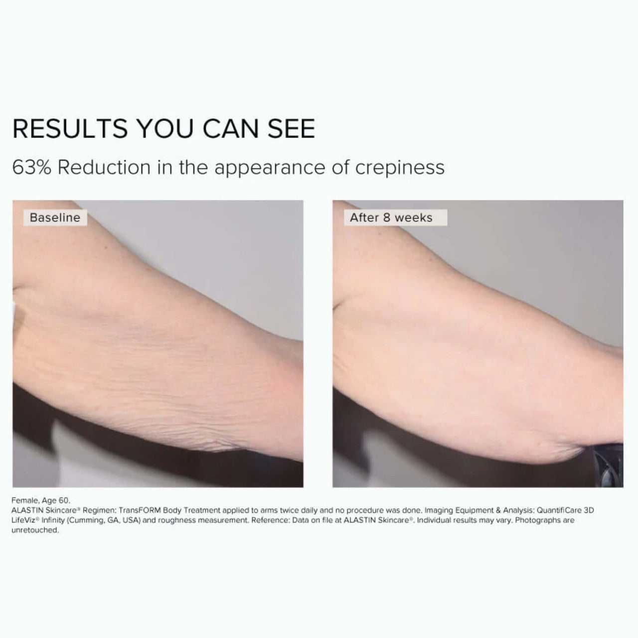 Skin Elite | TransFORM Body Treatment before + after
