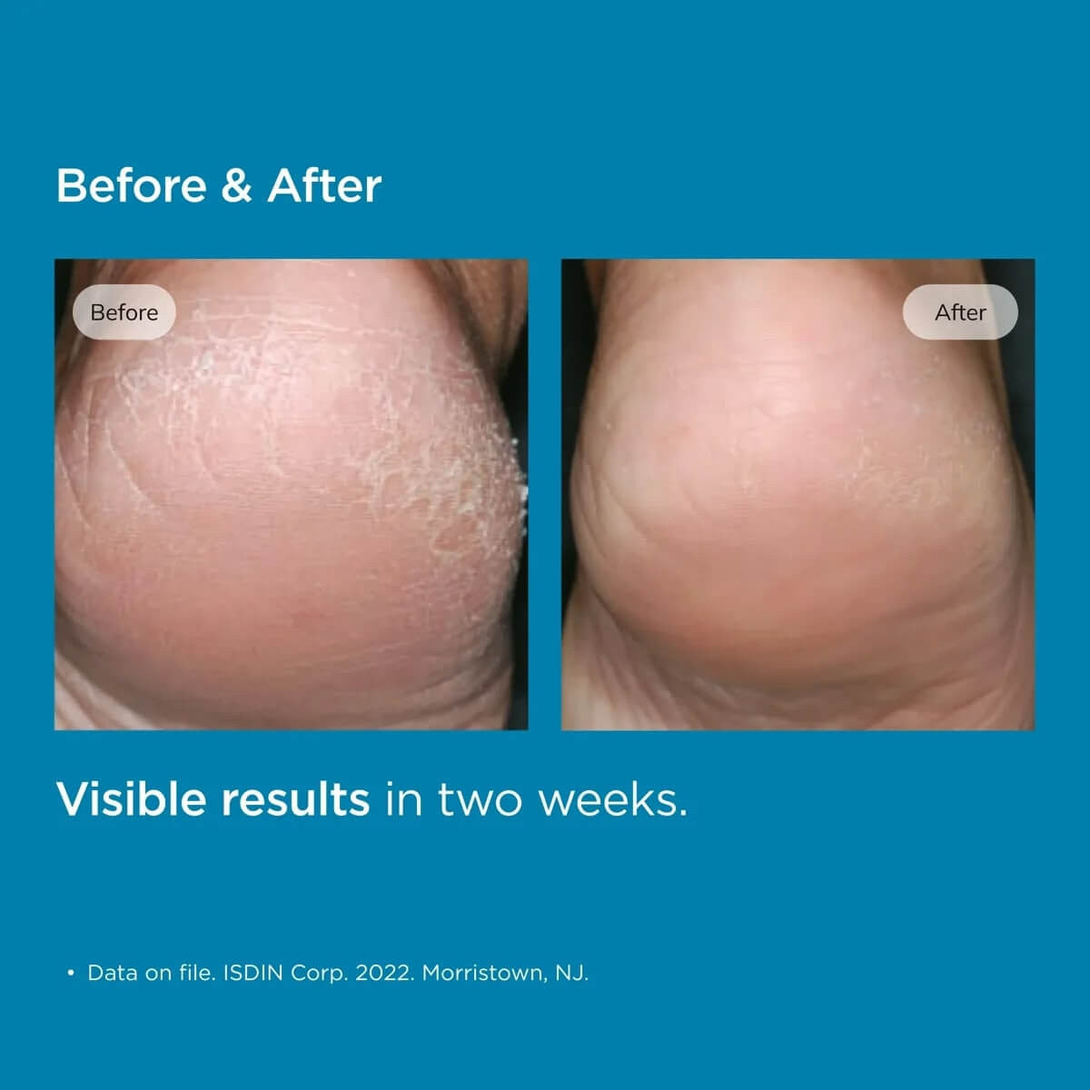 ISDIN Uradin Podos Hydrating Gel Oil 2.5 fl oz - SkinElite - before and after 