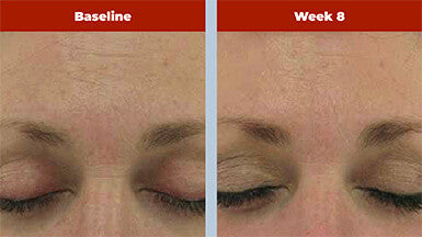 Biopelle Retriderm Serum Max 1 fl oz - SkinElite - before and after 1