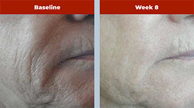 Biopelle Retriderm Serum Mild 1 fl oz - SkinElite - Before and After 2