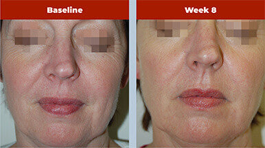 Biopelle Retriderm Serum Mild 1 fl oz - SkinElite - Before and After 1