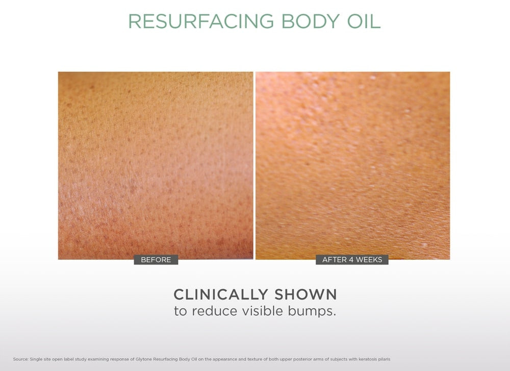 Glytone Resurfacing Body Oil 4 fl oz - SkinElite - before and after