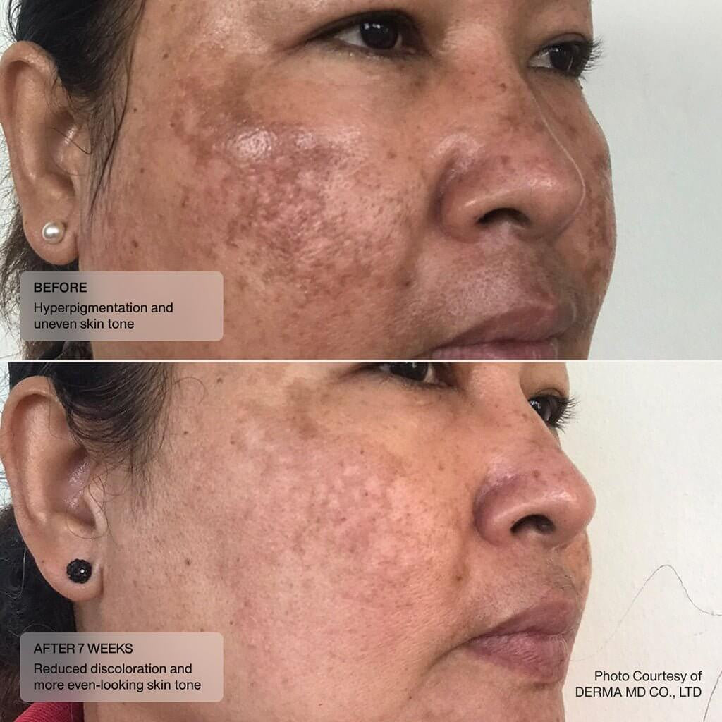 Senté Even Tone Retinol Cream 1 fl oz - SkinElite- before and after 3