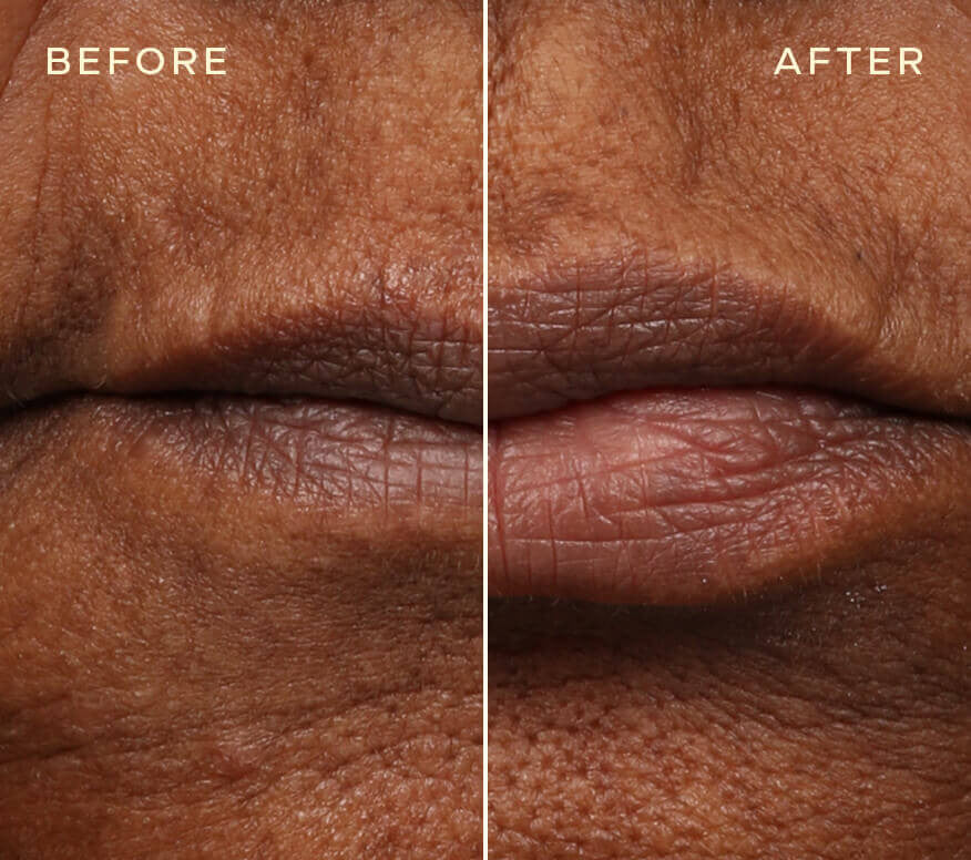 Ourself Lip Filler and Refill 2x 0.05 fl oz - SkinElite - before and after 3