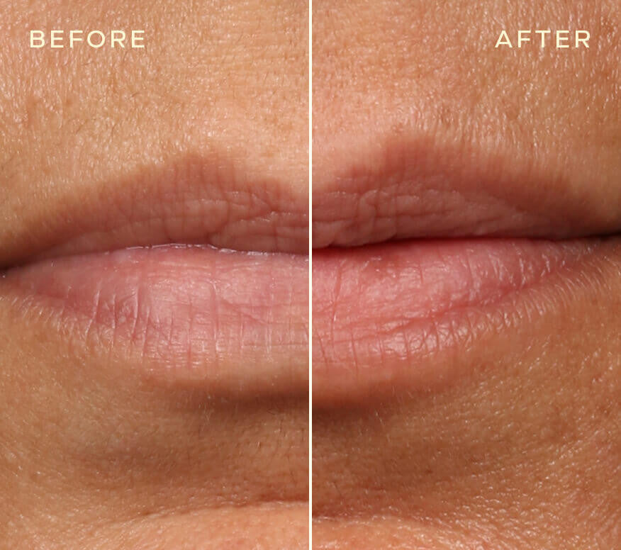 Ourself Lip Filler and Refill 2x 0.05 fl oz - SkinElite - before and after 1