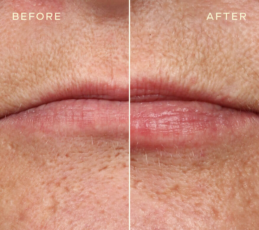 Ourself Lip Filler and Refill 2x 0.05 fl oz - SkinElite - before and after 2