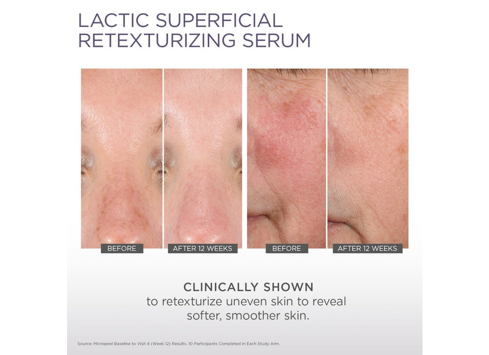 Glytone Lactic Superficial Retexturizing Serum 1 fl oz - SkinElite - results