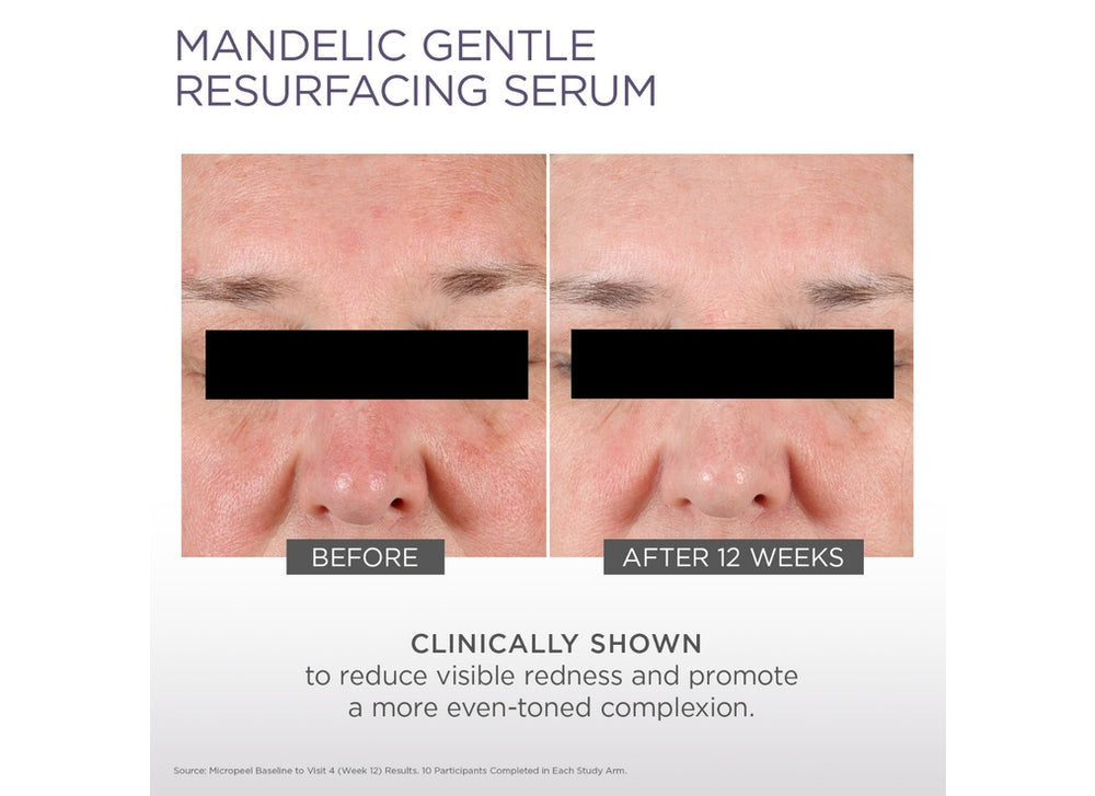 Glytone Mandelic Gentle Resurfacing Serum 1 fl oz - SkinElite - before and after