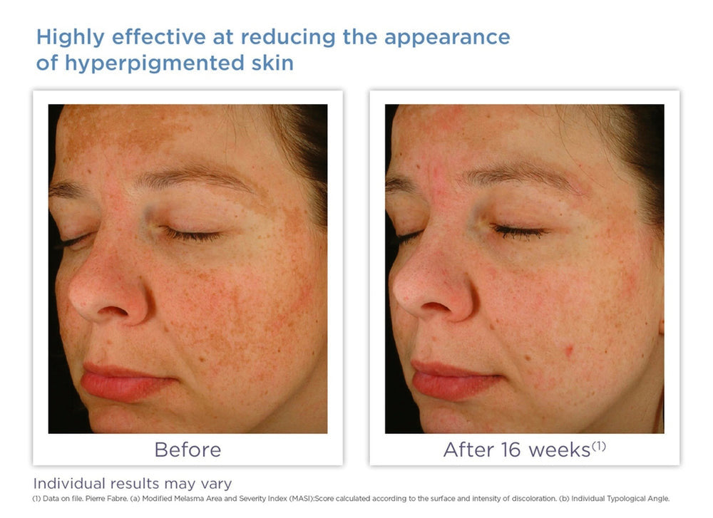 Glytone Enhance Brightening Complex 1 fl oz - SkinElite - before and after 2