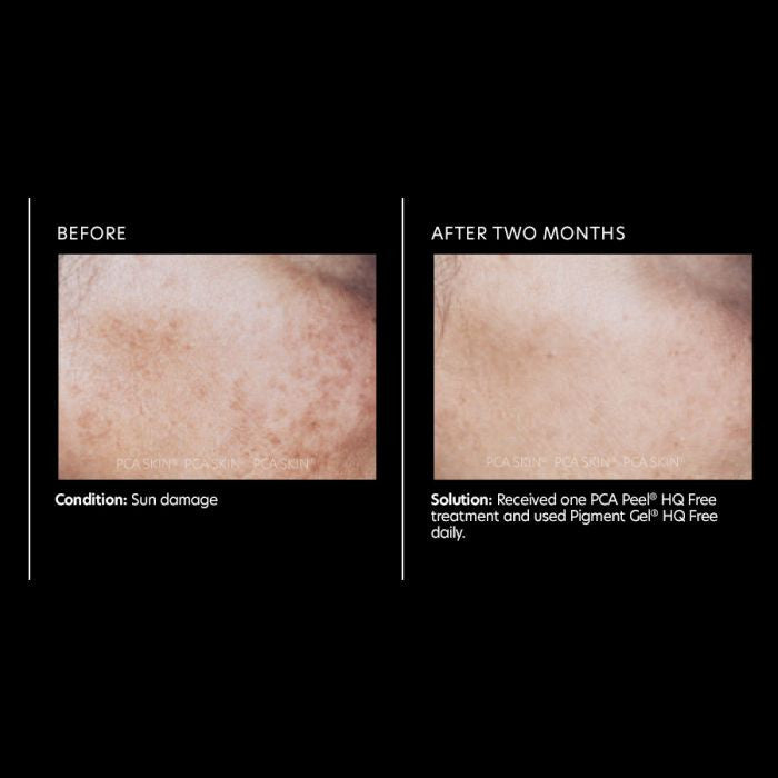 PCA Skin Pigment Gel HQ Free 1 fl oz - results 2