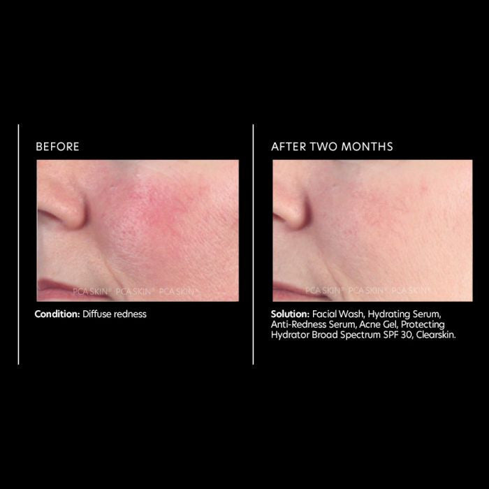 PCA Skin Anti-Redness Serum 1 fl oz - results
