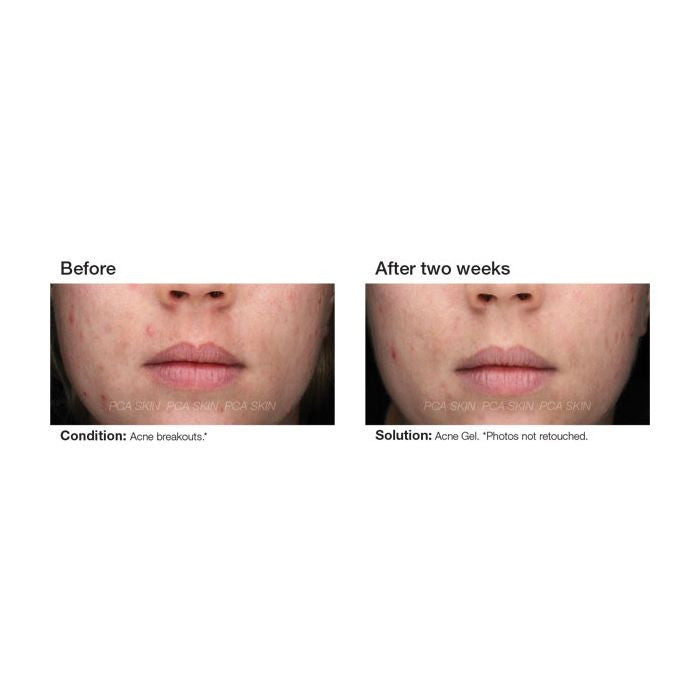 PCA Skin Acne Gel 1fl oz. - results