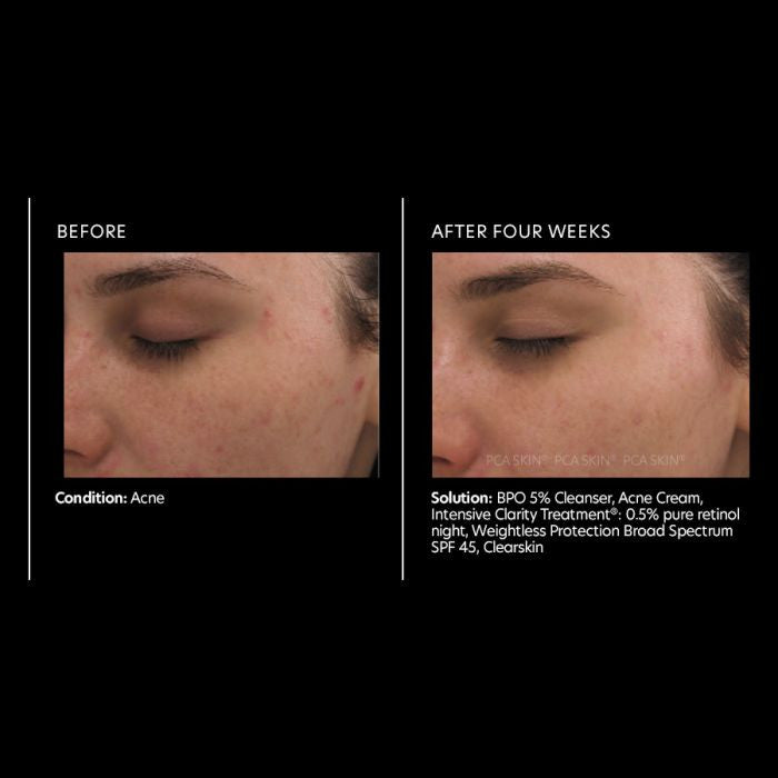 PCA Skin Intensive Clarity Treatment with Retinol and Salicylic Acid 1 fl oz - results 1
