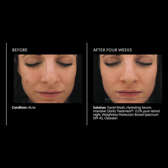 PCA Skin Intensive Clarity Treatment with Retinol and Salicylic Acid 1 fl oz - results 2