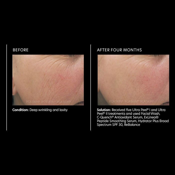 PCA Skin C-Quench Antioxidant Serum 1 fl oz - results
