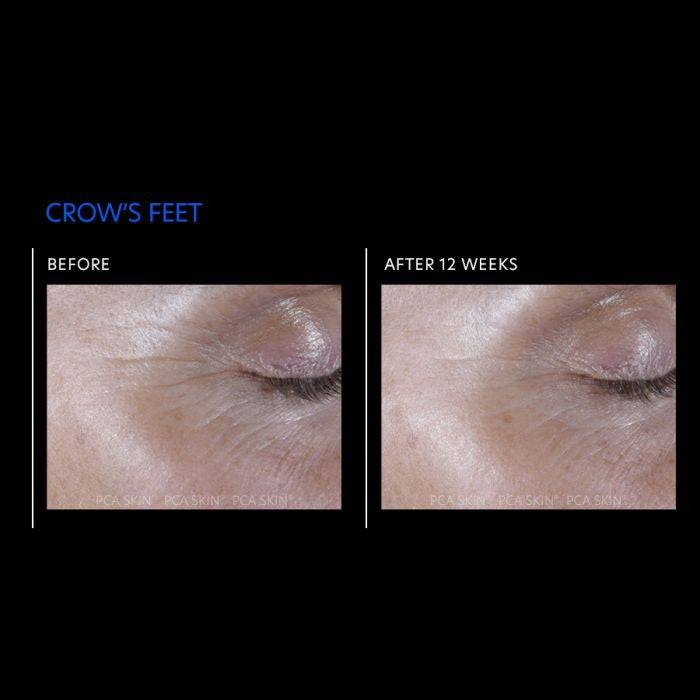 PCA Skin ExLinea Pro Peptide Smoothing Serum 1 fl oz - results 2