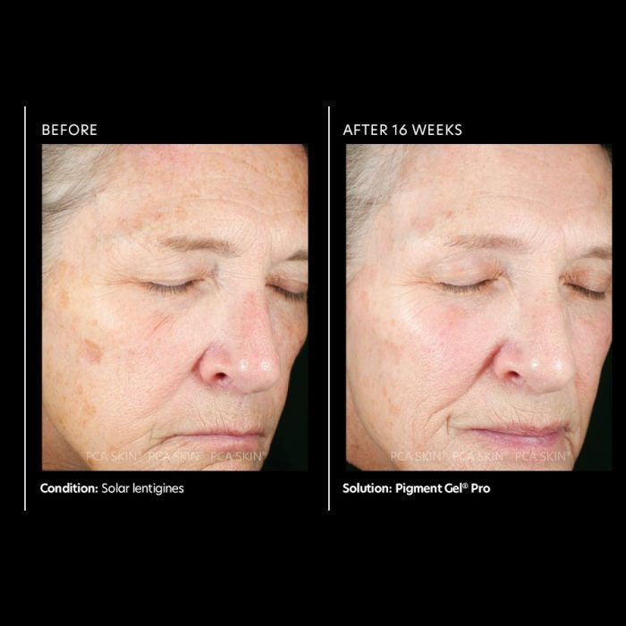 PCA Skin Pigment Gel Pro 1 oz - results 1