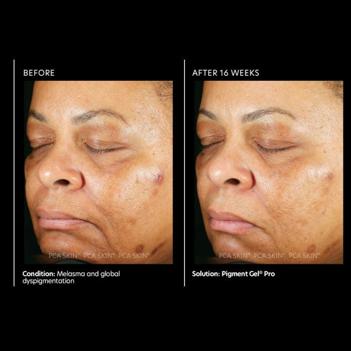 PCA Skin Pigment Gel Pro 1 oz - results 2