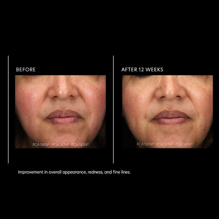 PCA Skin Resurfacing Serum 1 oz results