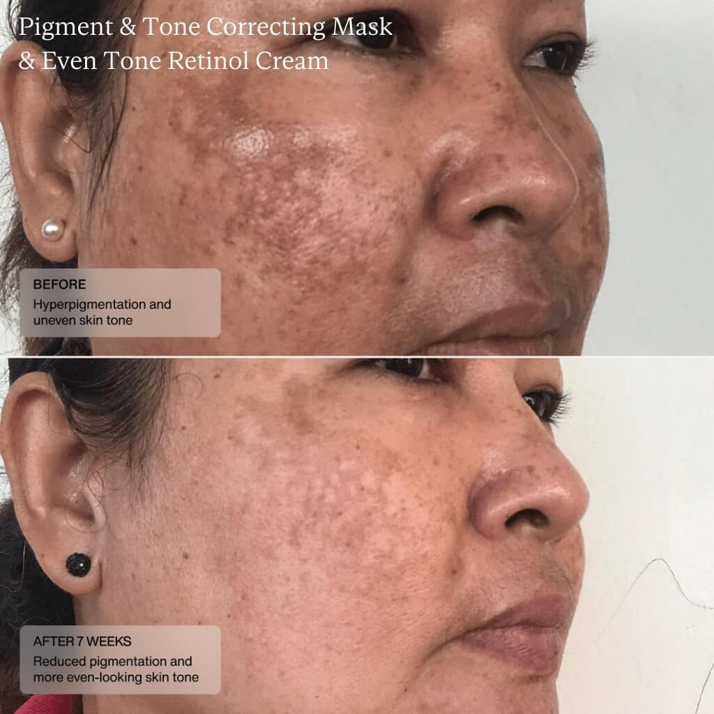 Senté Pigment & Tone Correcting Mask 1.7 fl oz - SkinElite - before and after 3