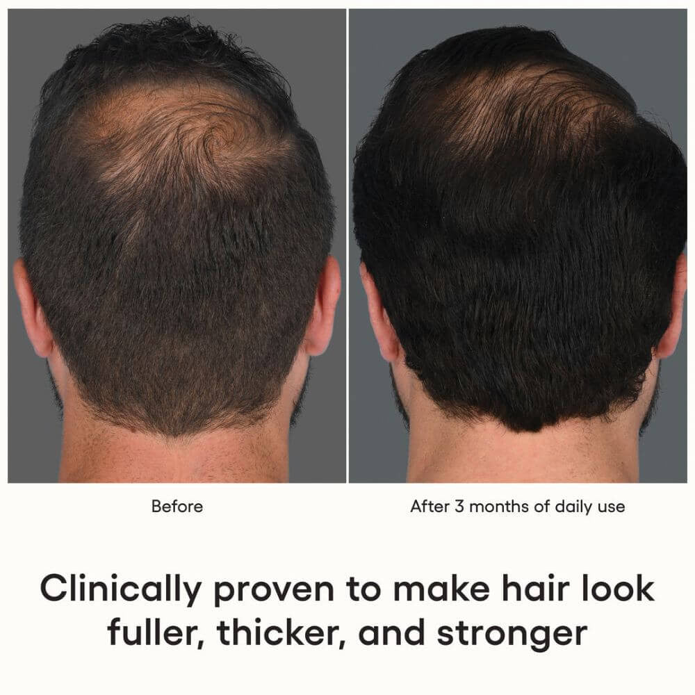 ( plated ) Skin Science HAIR Serum men before and after - SkinElite