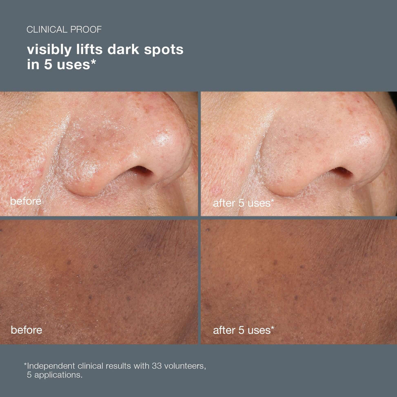 Dermalogica Powerbright Dark Spot Peel 1.7 fl oz - SkinElite - before and after