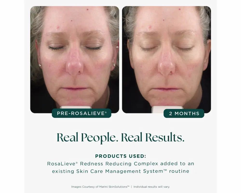 Jan Marini RosaLieve® 1 fl oz before and after