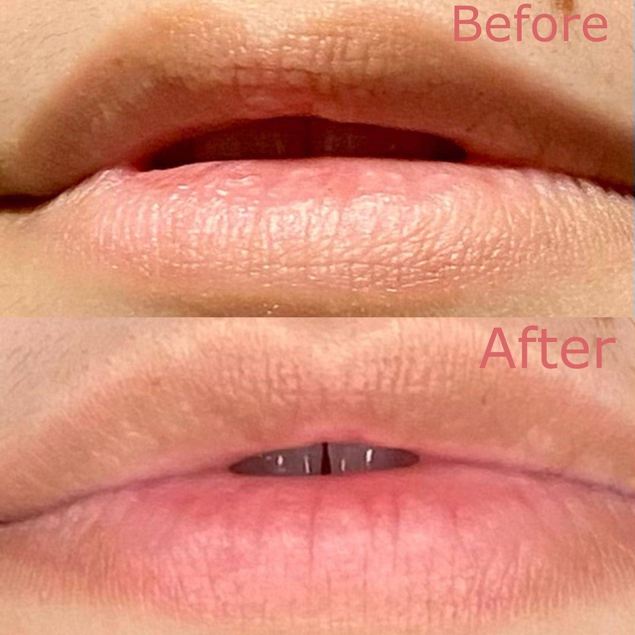 Patchology Rosé Lips Hydrating Lip Gels - 1 patch - SkinElite - before and after