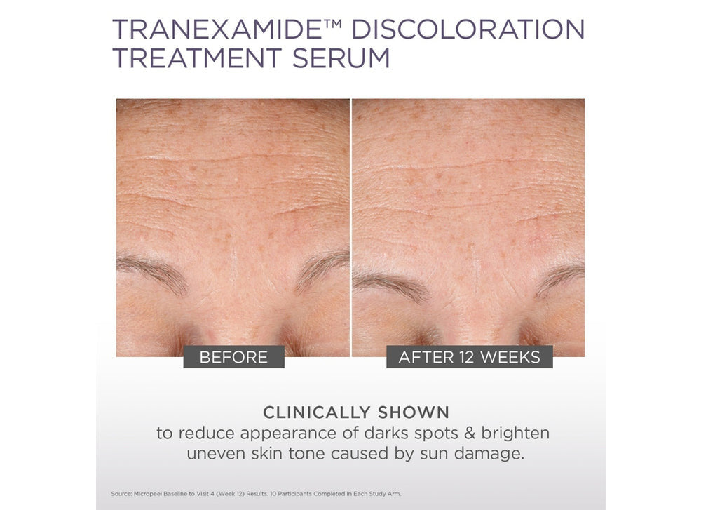 Glytone TranEXamide Discoloration Treatment Serum 1 fl oz - SkinElite - before and after