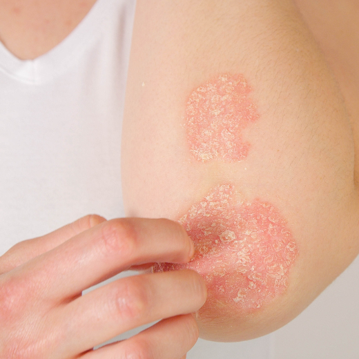 Eczema on Hand