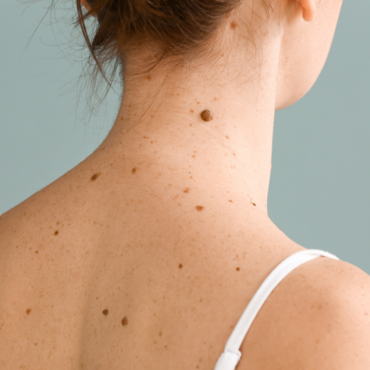 How to prevent Melanoma