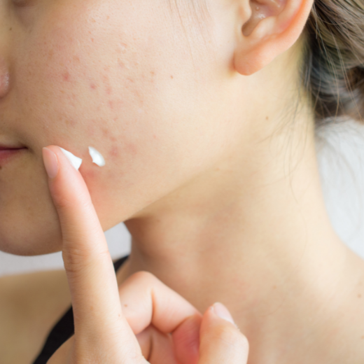 acne face