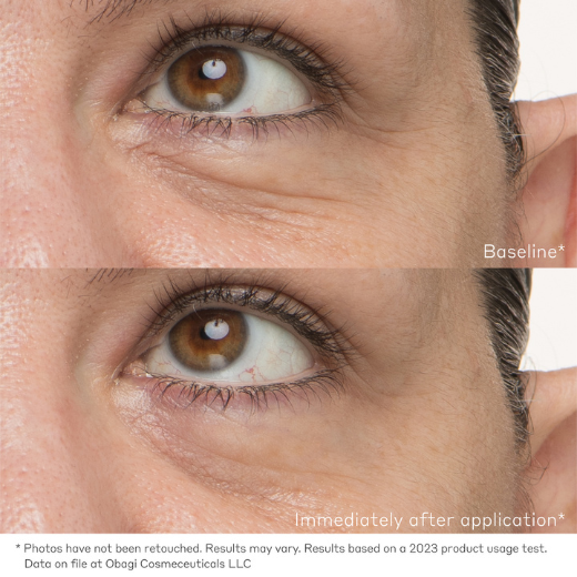 Under-eye area