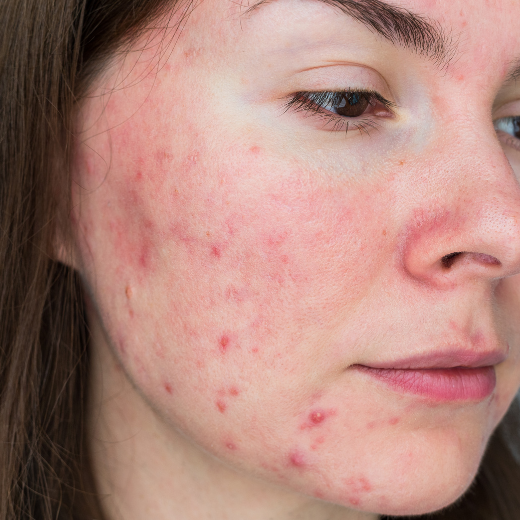 Red Pimples