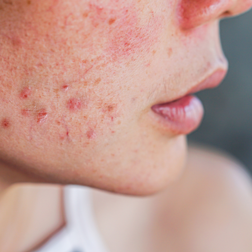 Skin Inflammation
