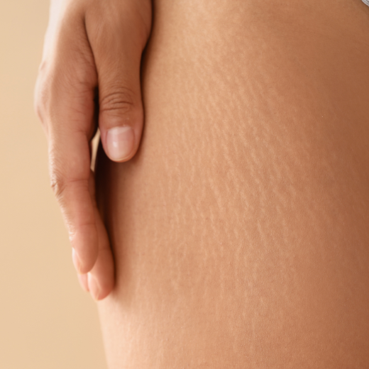Image of model showcasing stretch marks