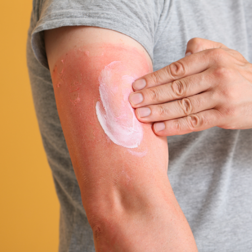 Applying Moisturizer to Sunburned Skin to Sooth Irritation
